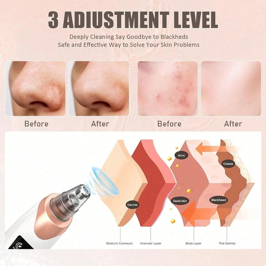 Blackhead Remover Pore Vacuum